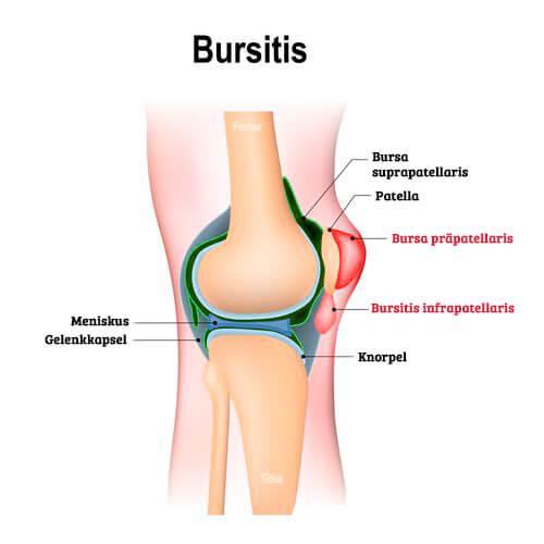 mehr über Bursitis