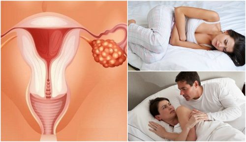 7 Symptome für Eierstockkrebs