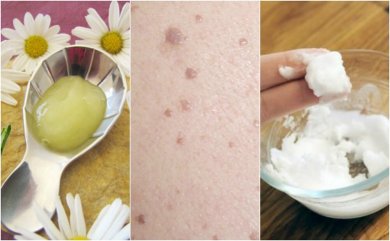 5 effektive Mittel gegen Flachwarzen