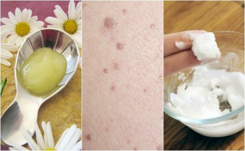 5 effektive Mittel gegen Flachwarzen