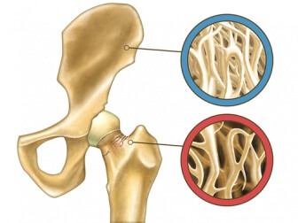 wissenswerte Dinge über Osteoporose