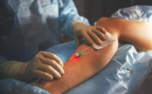 Möglichkeiten zur Behandlung von Krampfadern