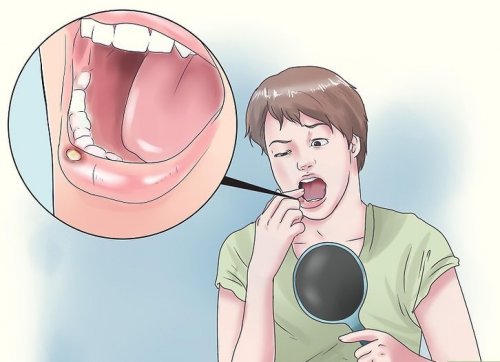 8 natürliche Heilmittel gegen Mundgeschwüre