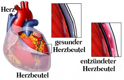 Herzstechen