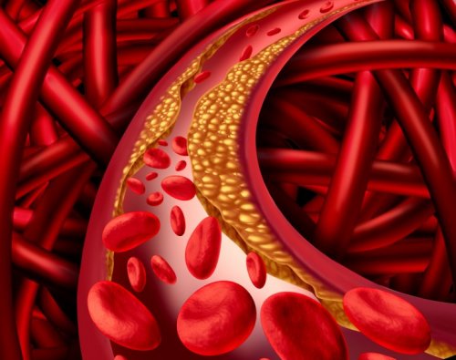 erhöhte Cholesterinwerte