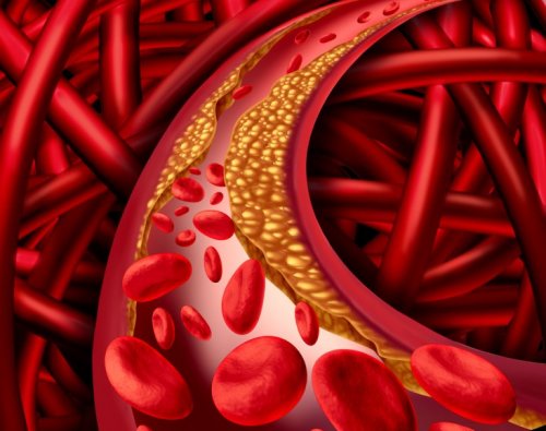 LDL-Cholesterin in den Arterien