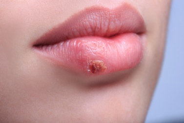 Lippenherpes durch Küsse