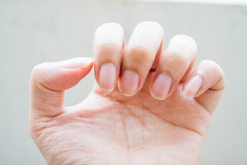 Geschädigte Fingenägel und Nagelveränderungen