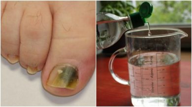 Natürliches Rezept gegen Nagelpilz