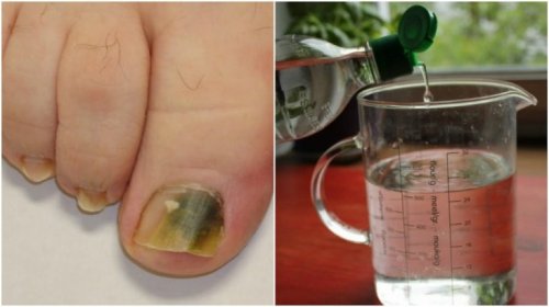 Natürliches Rezept gegen Nagelpilz