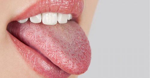 Eine Frau streckt eine trockene Zunge heraus, was ein Frühwarnzeichen für Diabetes sein könnte.
