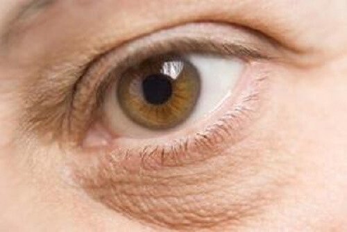 Geschwollene Augen sind ein Anzeichen für Nährstoffmangel