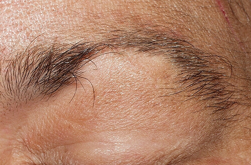 Haarausfall vor einem Herzinfarkt