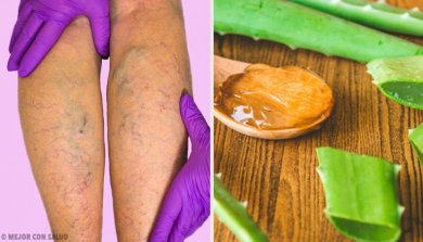 Hausmittel mit Aloe vera gegen Krampfadern