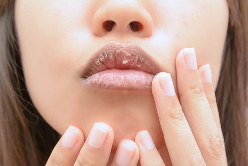 Rissige Lippen sind ein Anzeichen für Nährstoffmangel