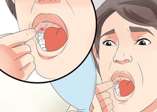Schwellung Nach Weisheitszahn Op Reduzieren Besser Gesund Leben