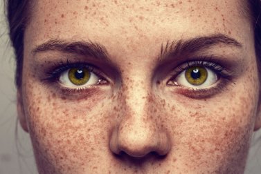 Sommersprossen entfernen auf ganz natürliche Weise