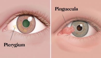 Augentumore: Pinguecula und Pterygium