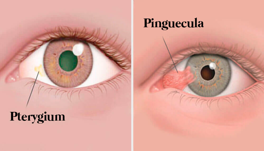 Augentumore: Pinguecula und Pterygium