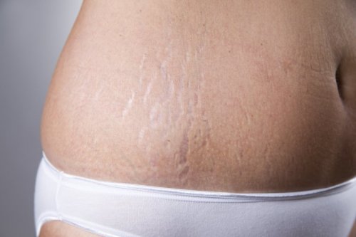 Vitamin-E-Kapseln gegen Dehungsstreifen