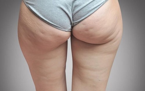 eine Flüssigkeitsretention kann zu Cellulite führen
