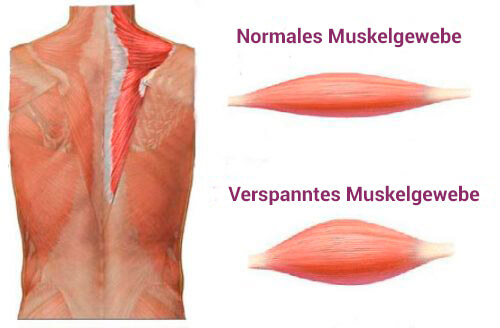 Muskelverspannungen
