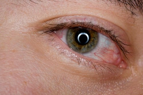 rote Augen sind Anzeichen eines Augentumors