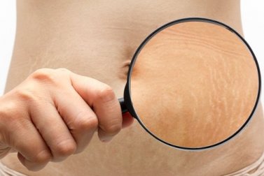 Was tun gegen Dehnungsstreifen? 6 Tipps