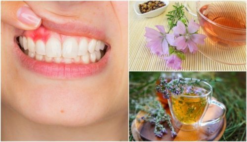 5 Naturheilmittel gegen Gingivitis