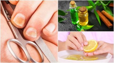 5 Tricks zur Bekämpfung von Nagelmykose