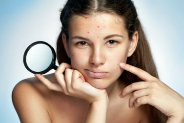 6 Tipps gegen Akne