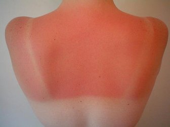 Was tun gegen Sonnenbrand? Vorsorge und Behandlung