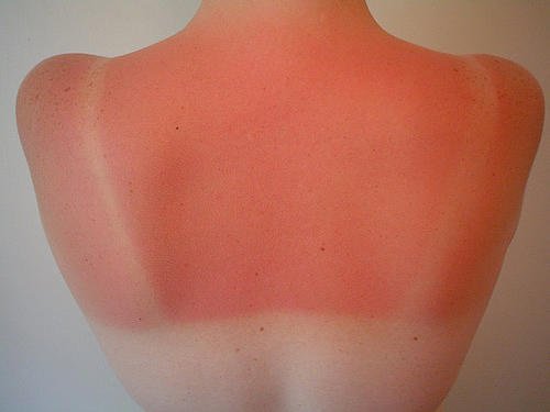 Was tun gegen Sonnenbrand? Vorsorge und Behandlung