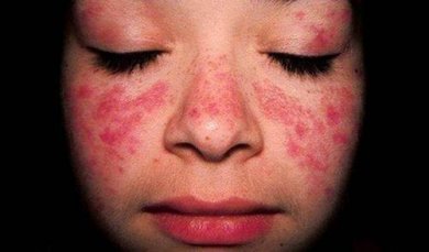 Behandlung von Systemischem Lupus Erythematodes (SLE)