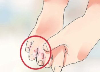 Wie du Fußpilz natürlich behandeln kannst
