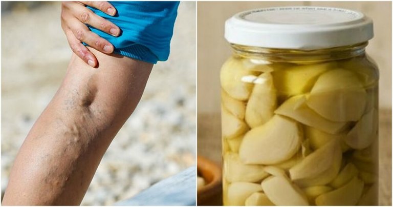 Knoblauch und Orange als Heilmittel gegen Krampfadern