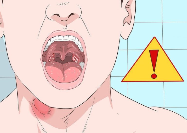 5 Anzeichen für Knoten im Rachen
