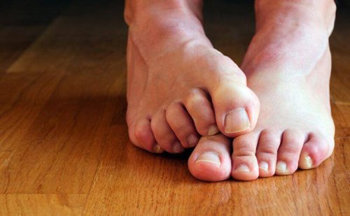 Nagelmykose an Zehennägeln