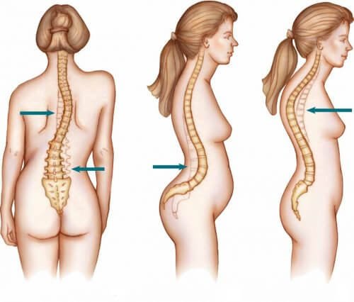 Skoliose betrifft Frauen häufig
