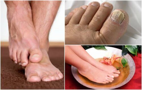 Zeigst du Symptome von Fußpilz?