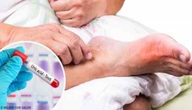5 Ursachen für erhöhte Harnsäurewerte