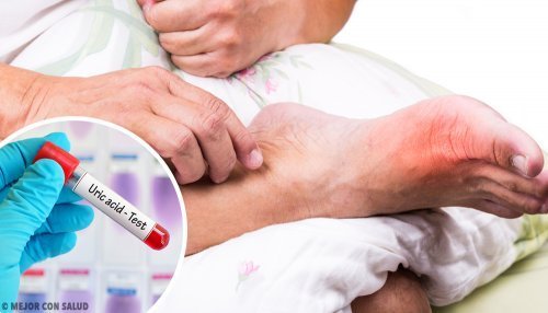 5 Ursachen für erhöhte Harnsäurewerte