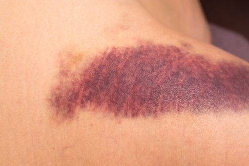 Rote Flecken aufgrund von Vitamin-K-Mangel