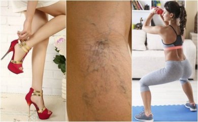 10 Tipps zur Vorsorge gegen Krampfadern