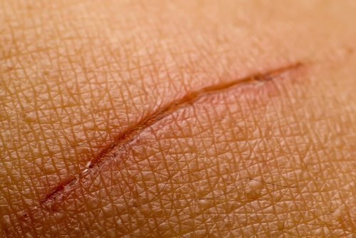 Anzeichen für Diabetes: schlechte Wundheilung