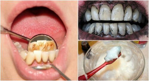 3 effektive Behandlungen gegen Zahnstein