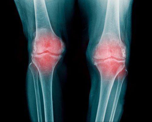 Rheumatoide Arthritis kann zu Kribbelgefühl führen