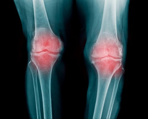 Ursachen von Gelenkschmerzen am Knie