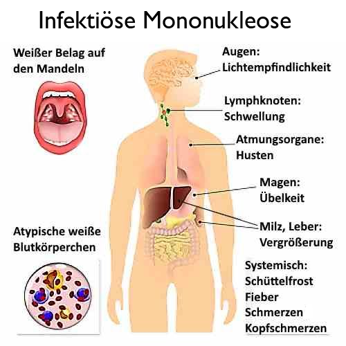 infektiöse Mononukleose