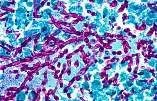 Vaginale Infektionen: Vaginale Kandidose